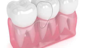 DIY Broken Tooth Repair